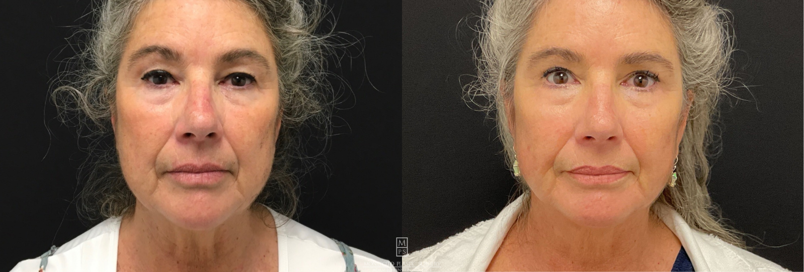 Woman Face Lift Before and After Front Profile