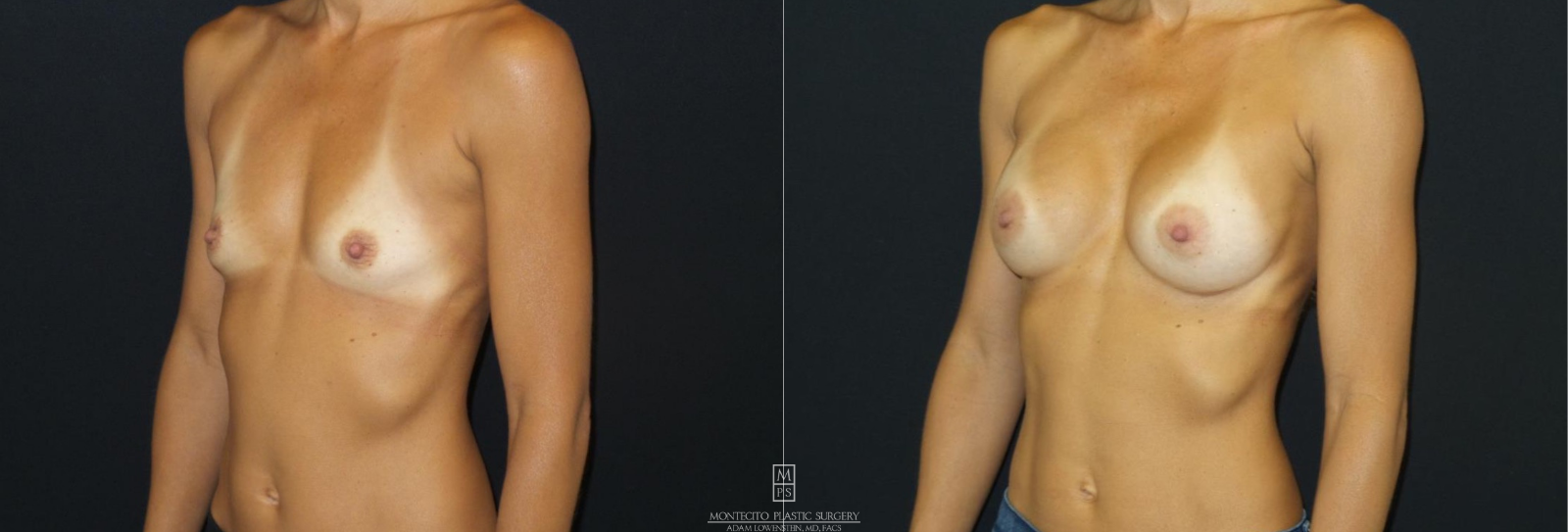Breast Augmentation BEFORE AND AFTER LEFT 45 VIEW