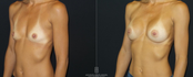 Breast Augmentation BEFORE AND AFTER LEFT 45 VIEW