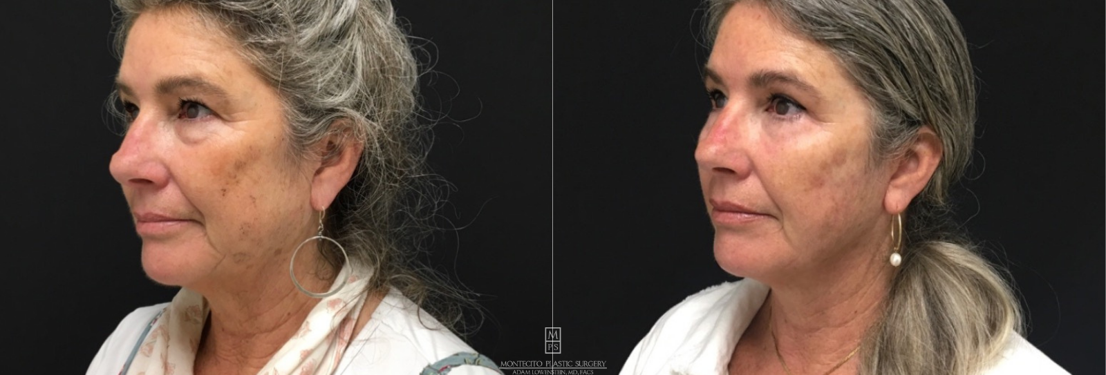 Woman Face Lift Before and After side Profile