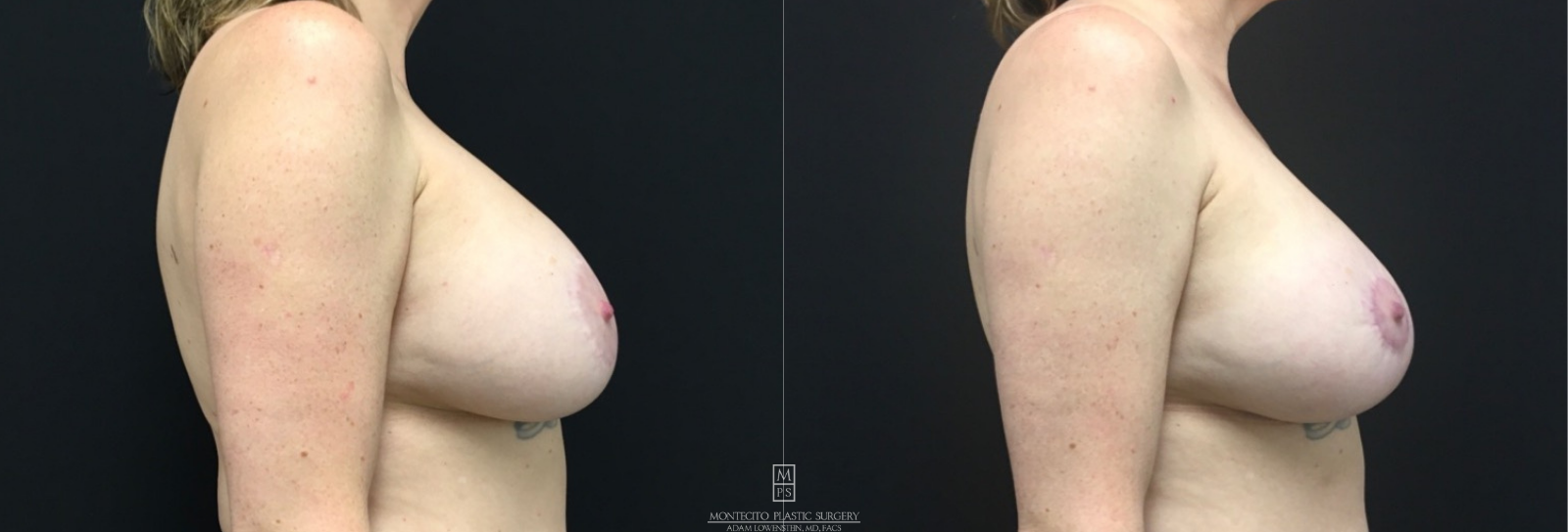 Breast Revision before and after Profile