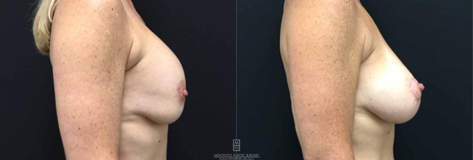 Breast Revision before and after side