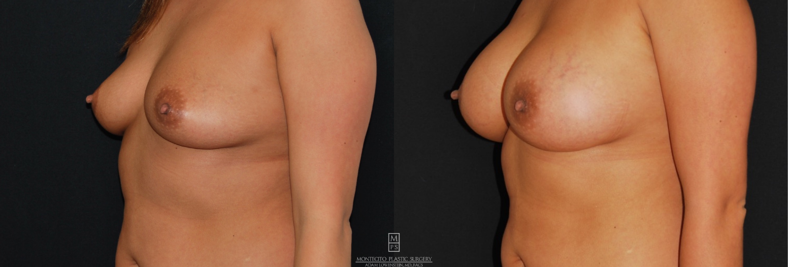 Breast Augmentation Results 45 profile view