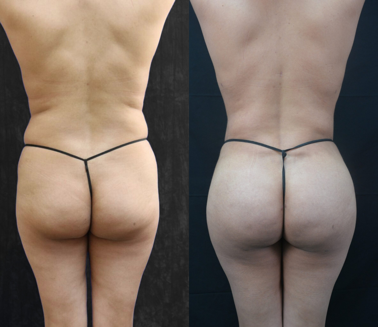 Woman before and after having Brazilian butt lift (BBL) surgery.