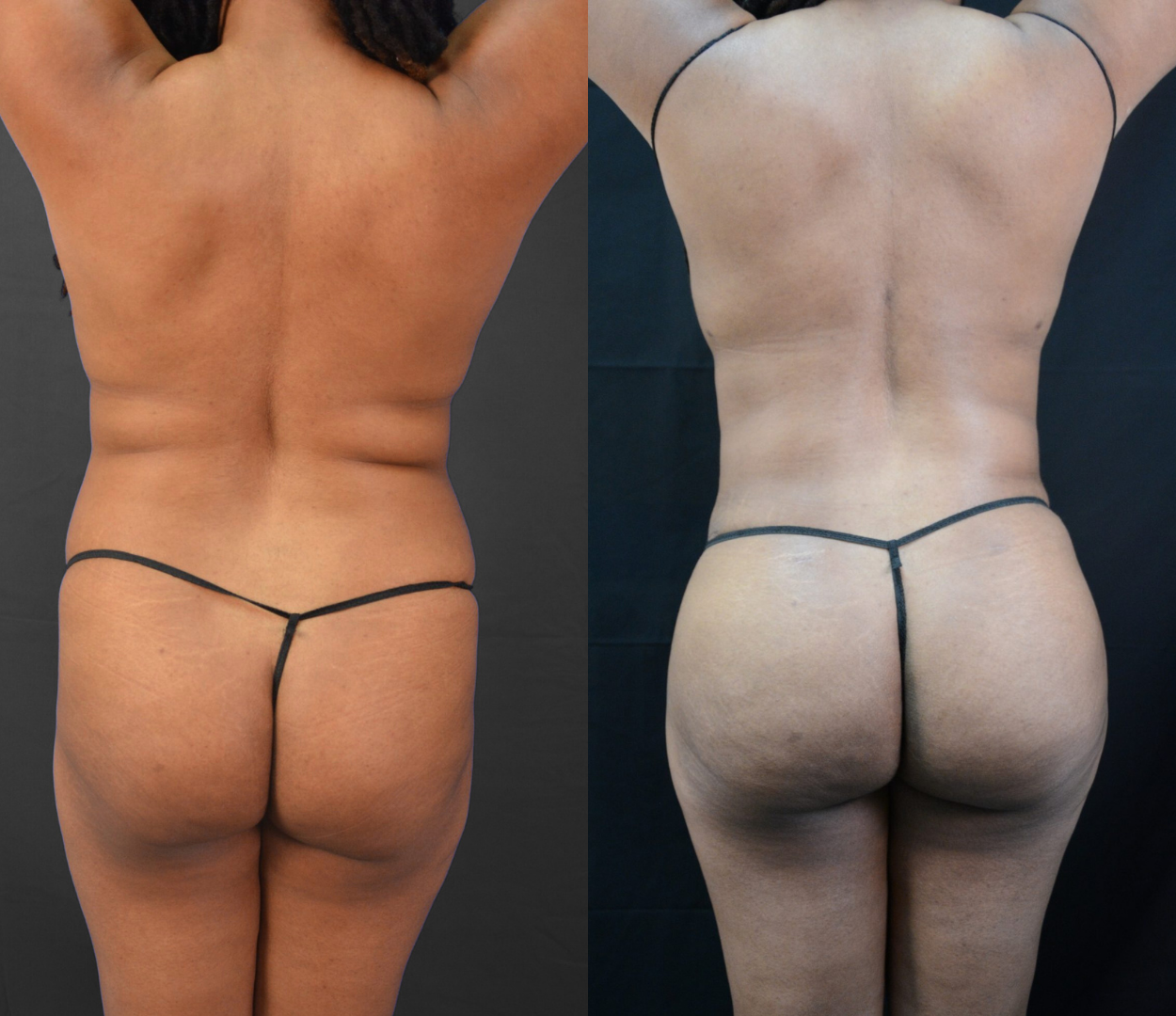 Woman before and after having Brazilian butt lift (BBL) surgery.