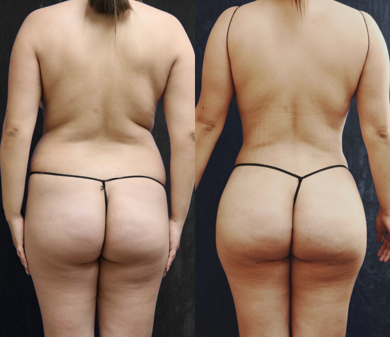 Woman before and after having Brazilian butt lift (BBL) surgery.