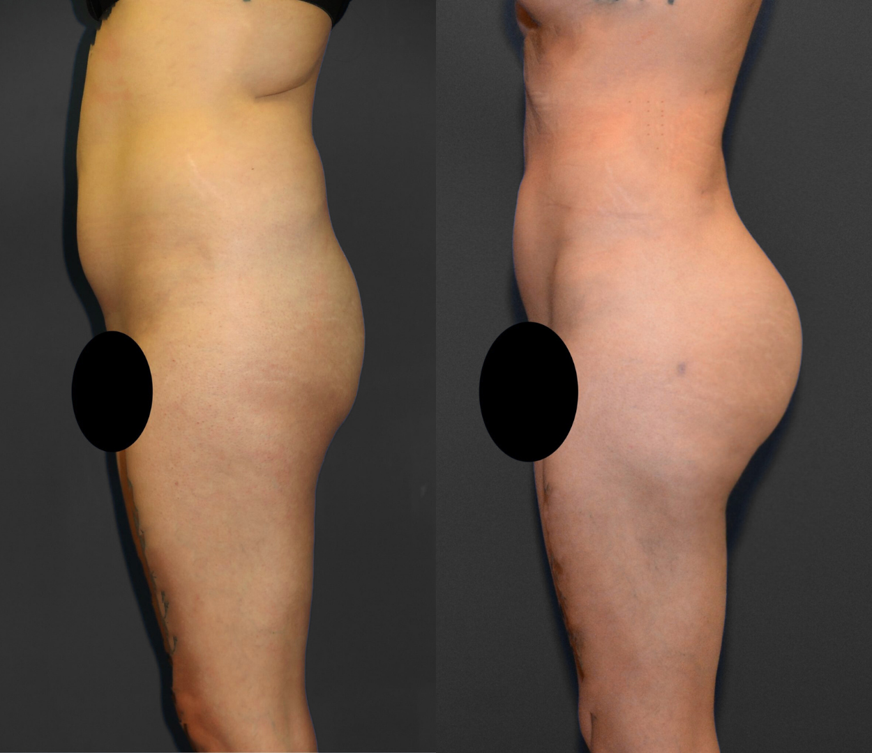 Woman before and after having Brazilian butt lift (BBL) surgery.