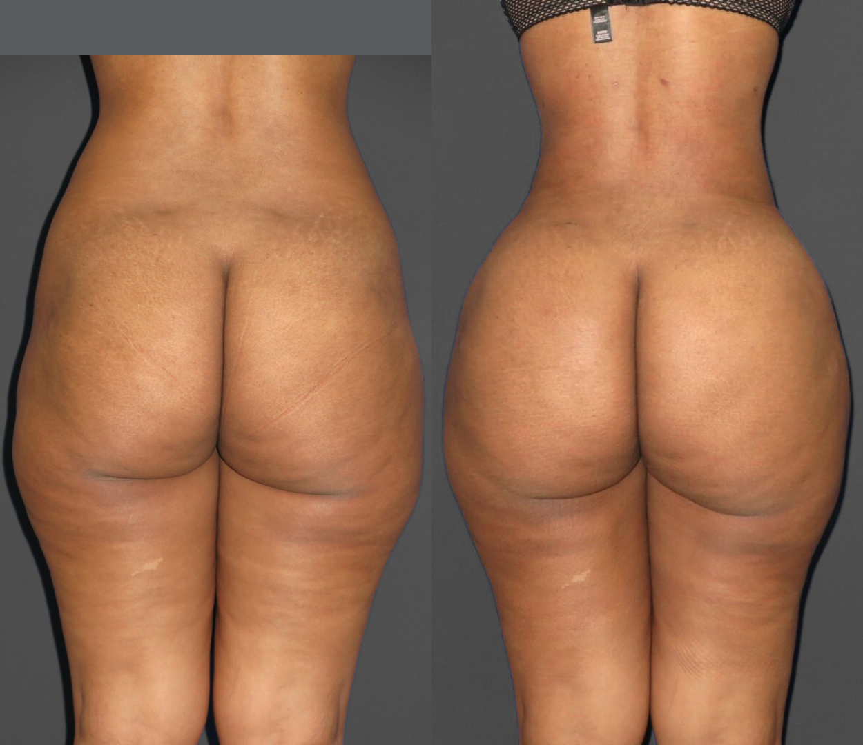 Woman before and after having Brazilian butt lift (BBL) surgery.