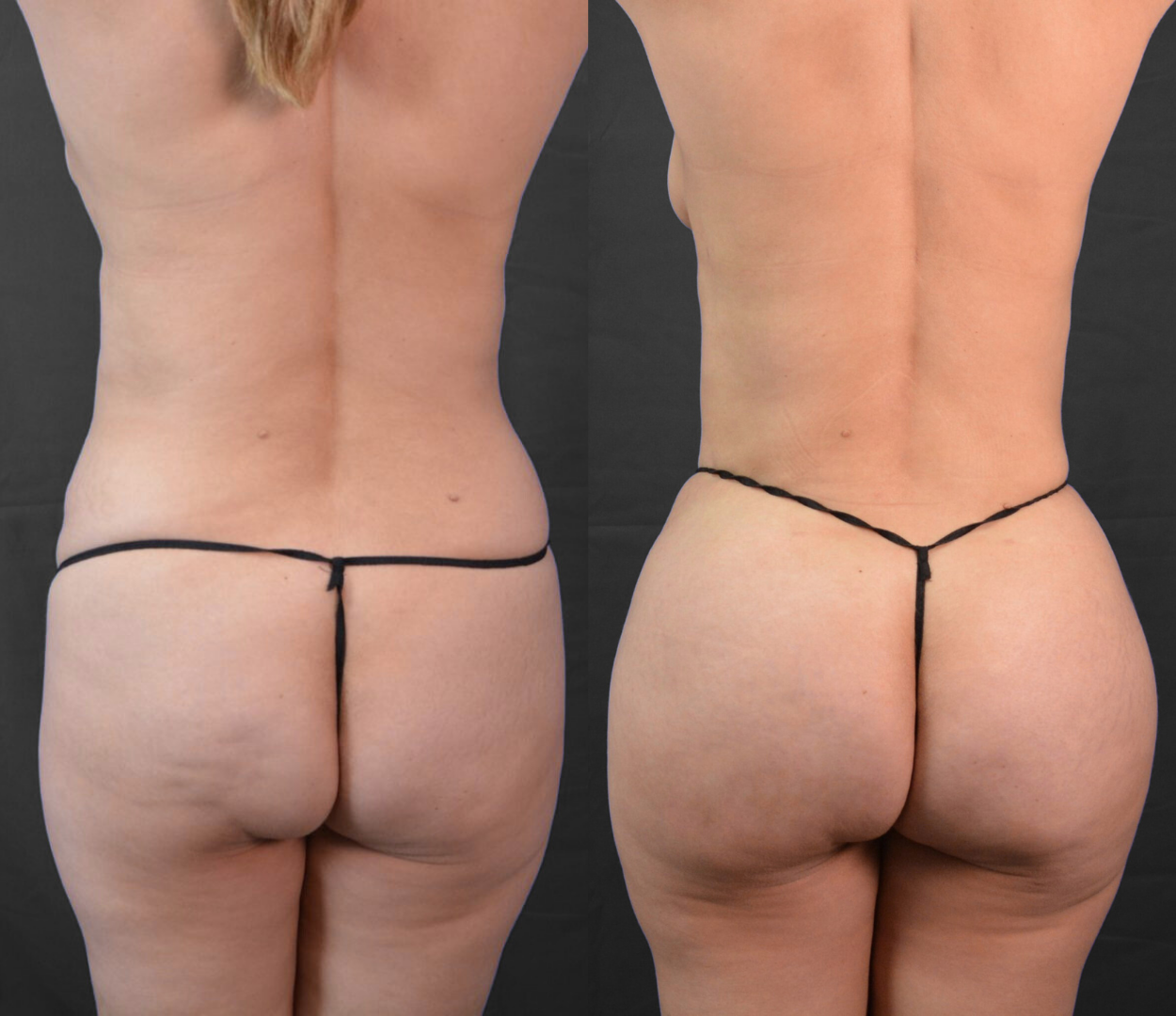Woman before and after having Brazilian butt lift (BBL) surgery.