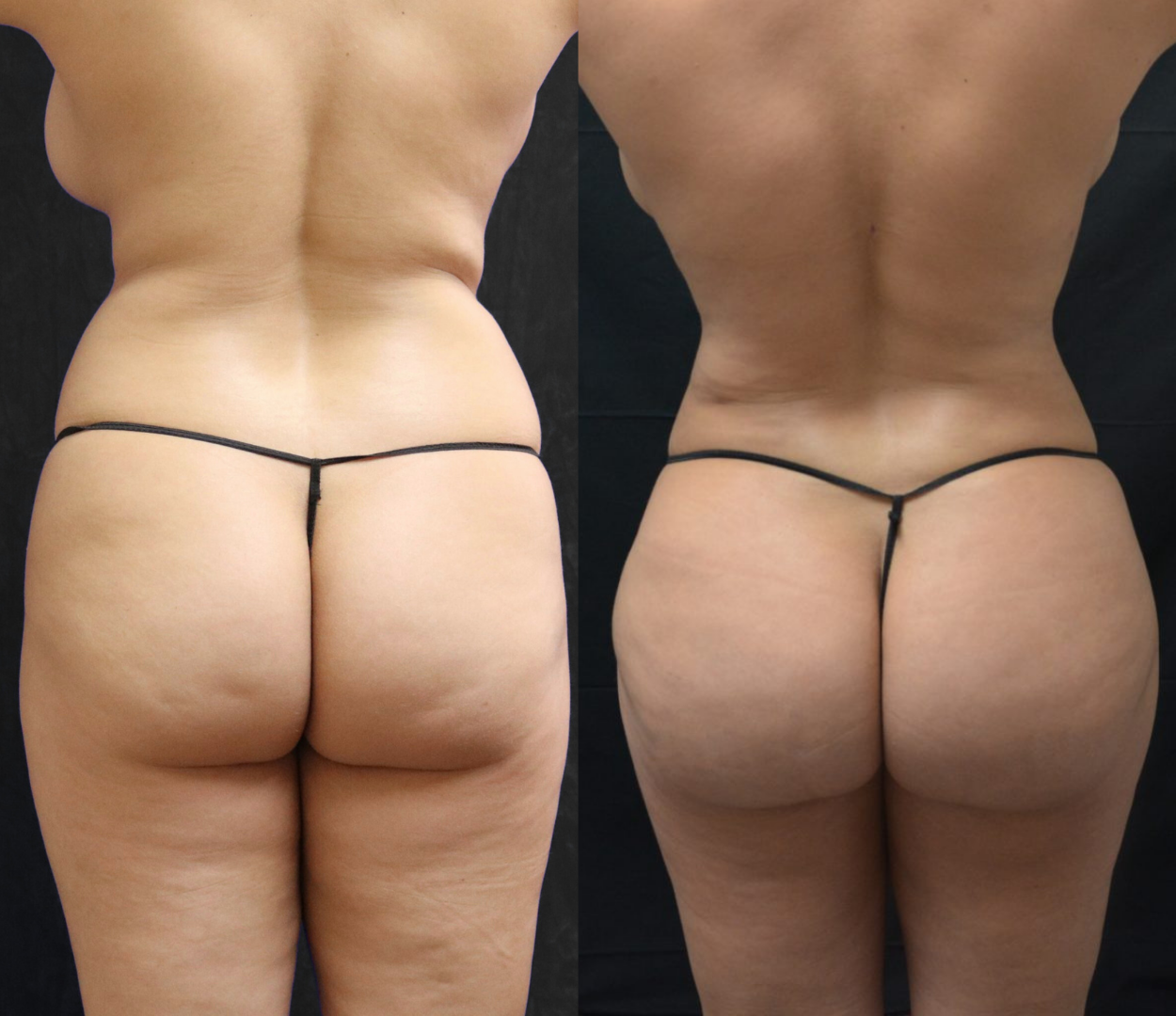 Woman before and after having Brazilian butt lift (BBL) surgery.
