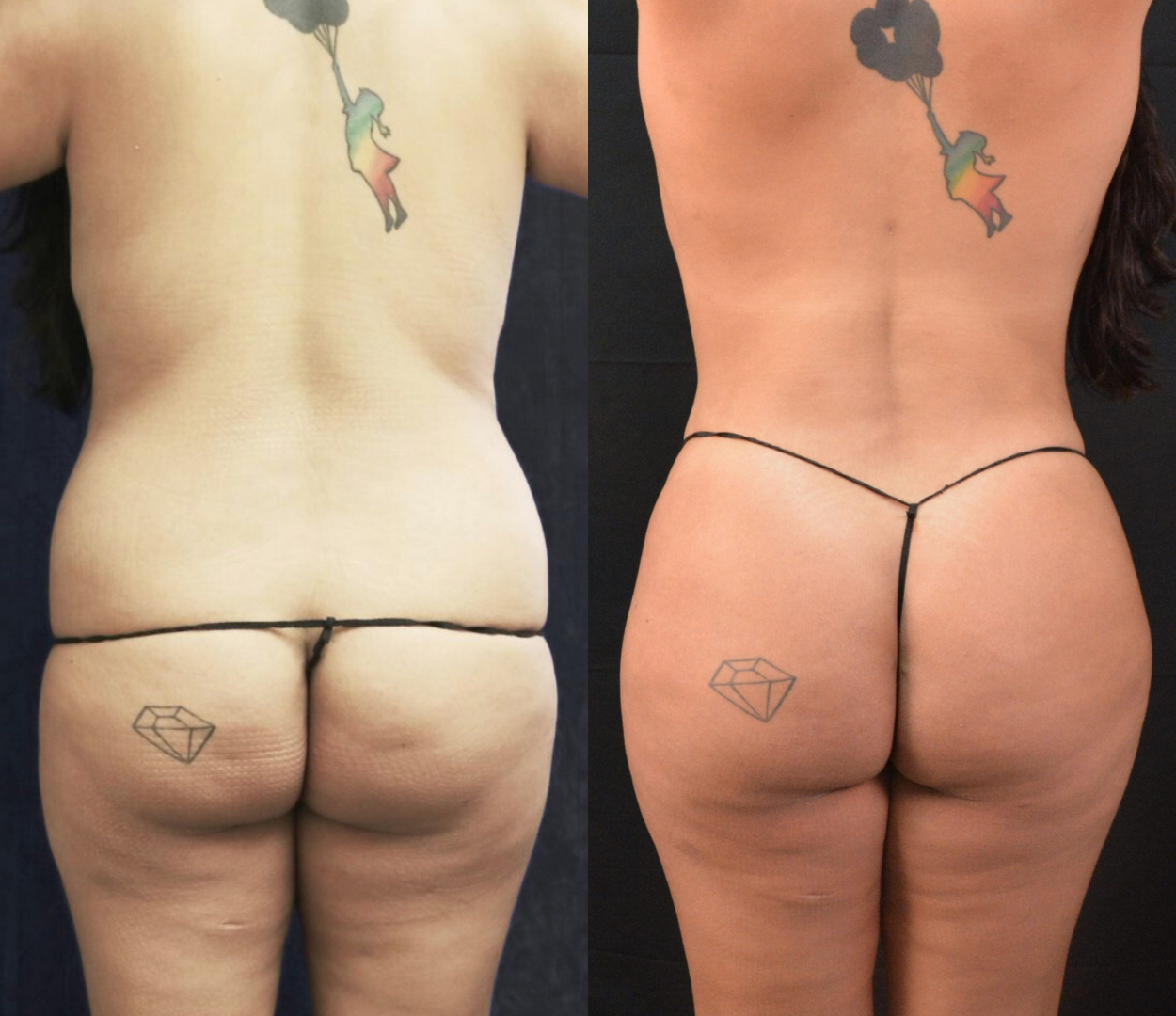 Woman before and after having Brazilian butt lift (BBL) surgery.