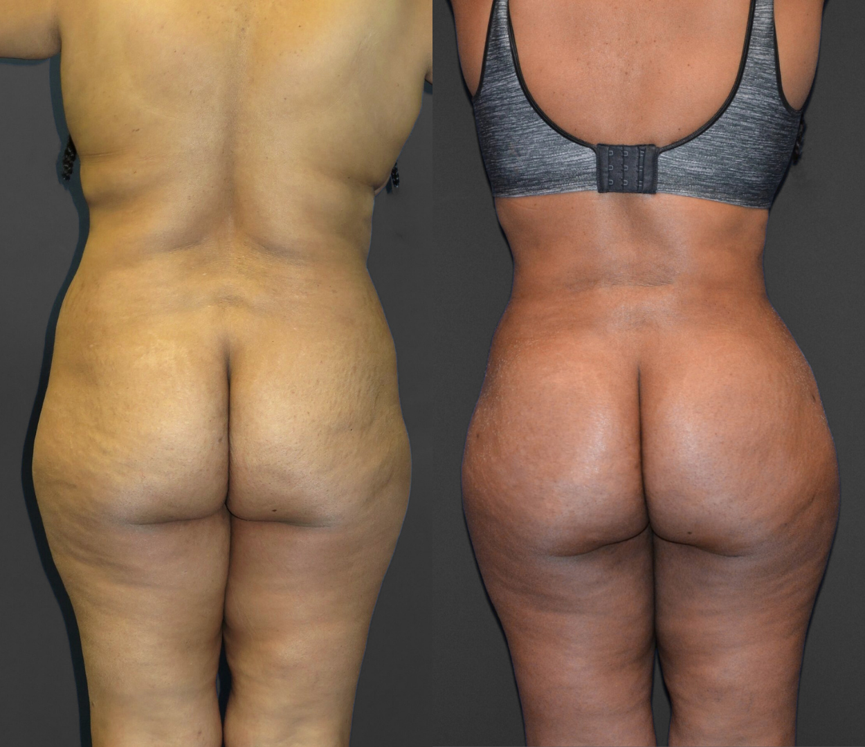 Woman before and after having Brazilian butt lift (BBL) surgery.