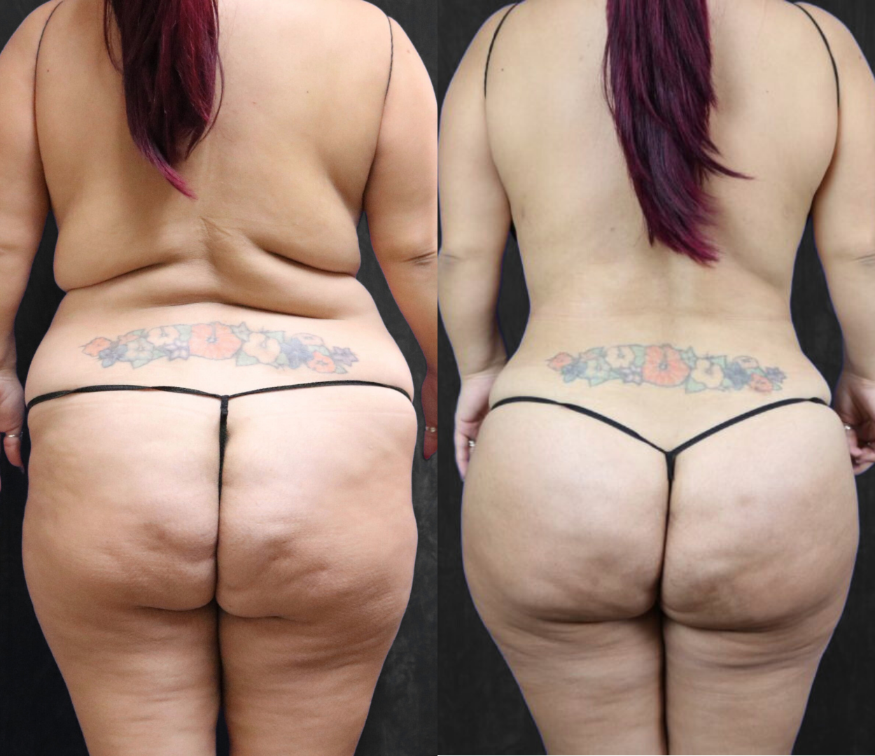 Woman before and after having Brazilian butt lift (BBL) surgery.