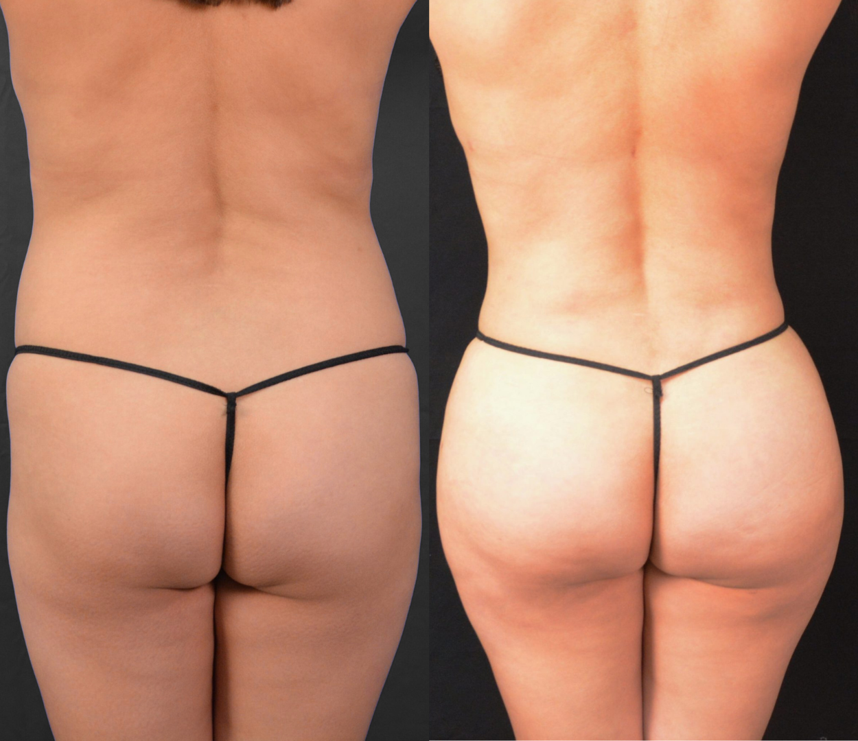 Woman before and after having Brazilian butt lift (BBL) surgery.