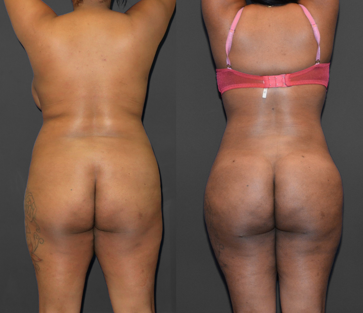 Woman before and after having Brazilian butt lift (BBL) surgery.