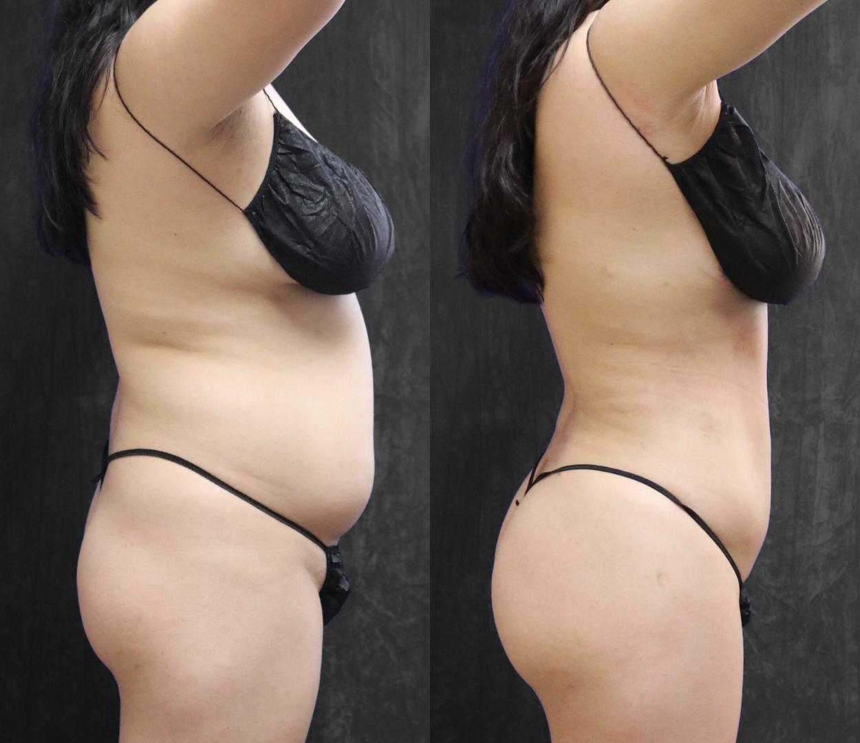 Woman before and after having Brazilian butt lift (BBL) surgery.