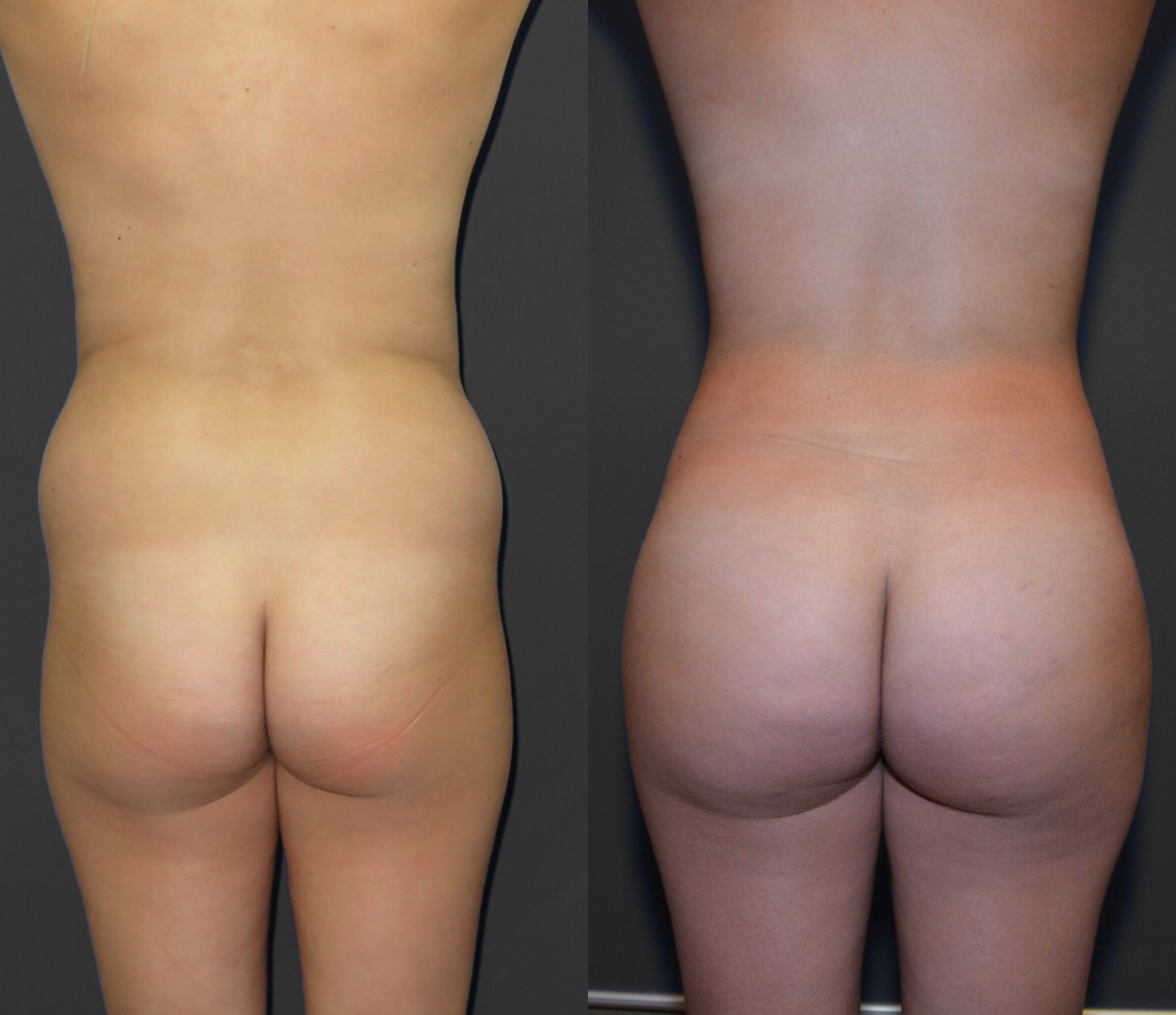 Woman before and after having Brazilian butt lift (BBL) surgery.