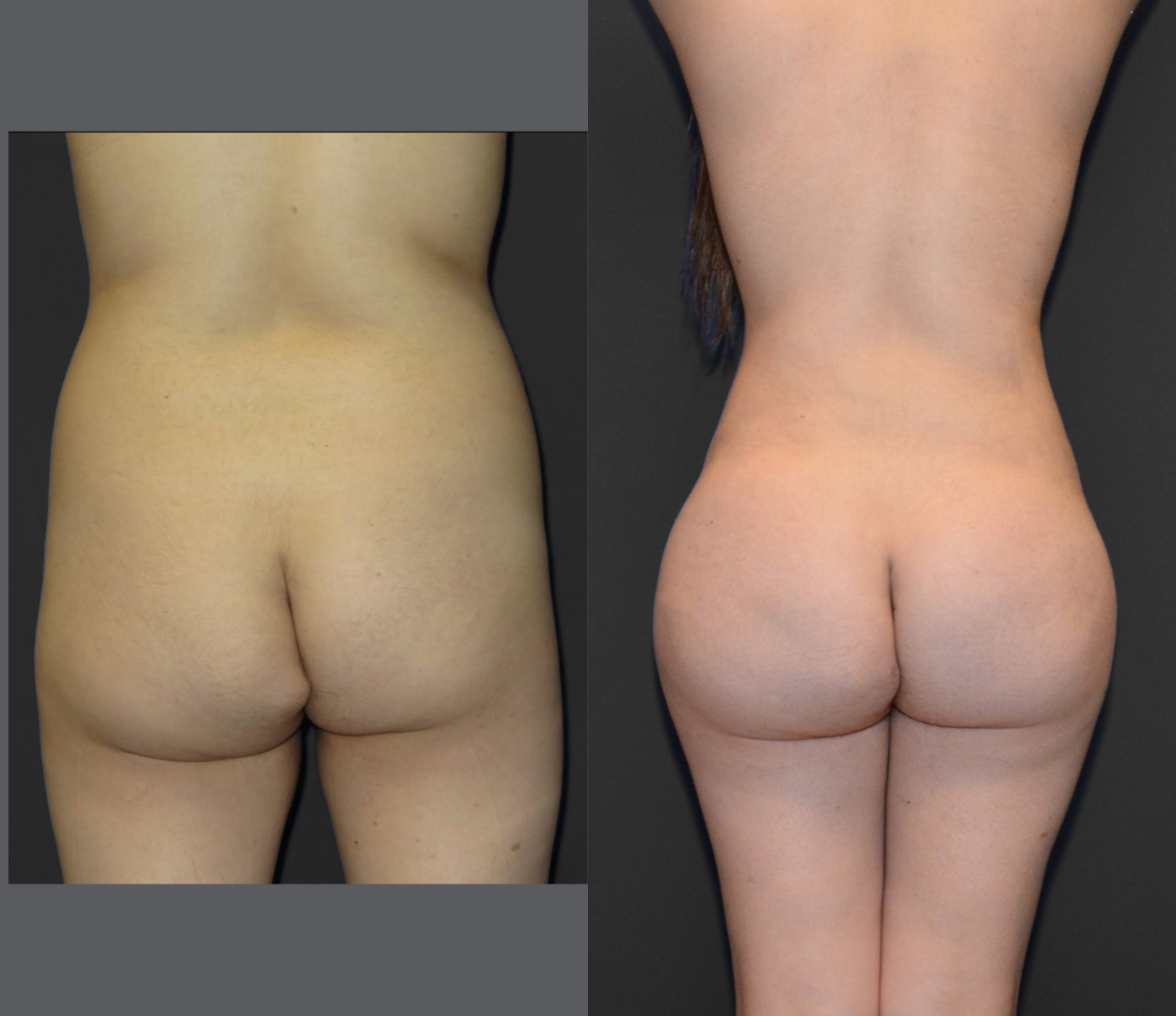 Woman before and after having Brazilian butt lift (BBL) surgery.