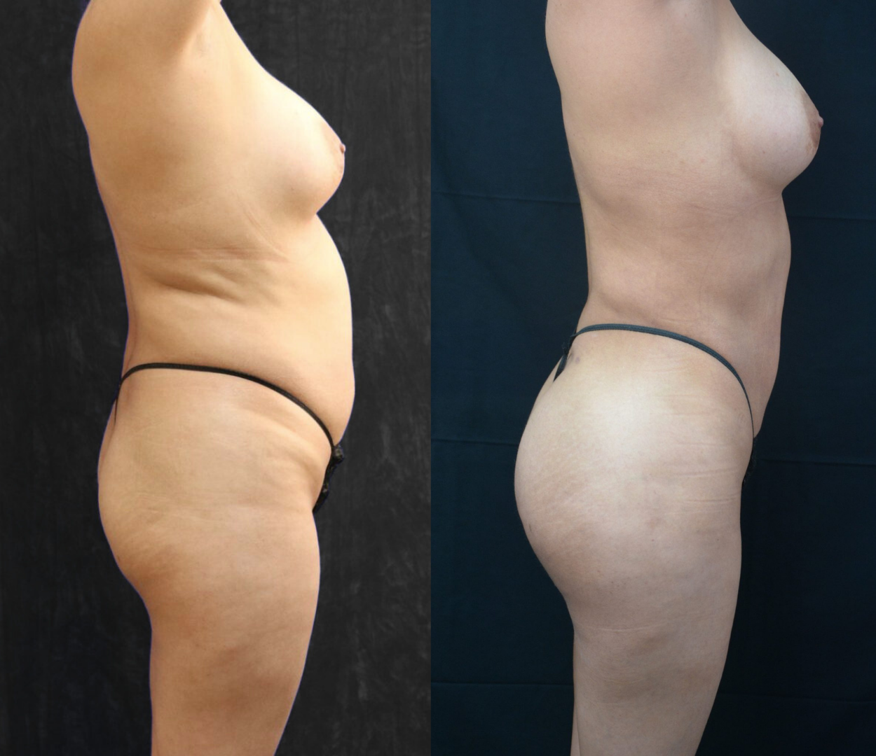 Woman before and after having Brazilian butt lift (BBL) surgery.