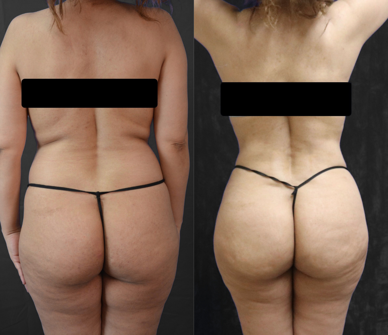 Woman before and after having Brazilian butt lift (BBL) surgery.