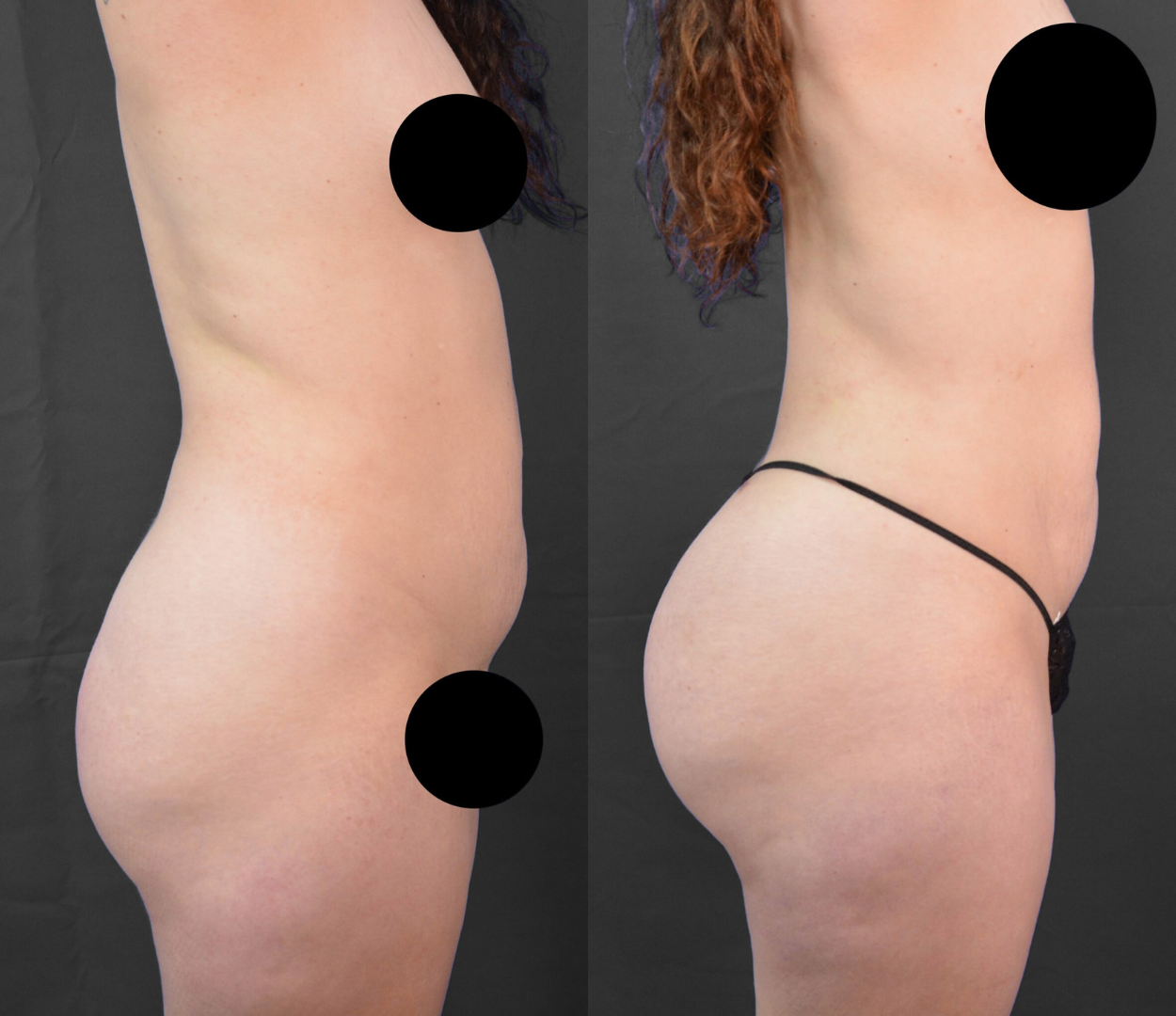 Woman before and after having Brazilian butt lift (BBL) surgery.