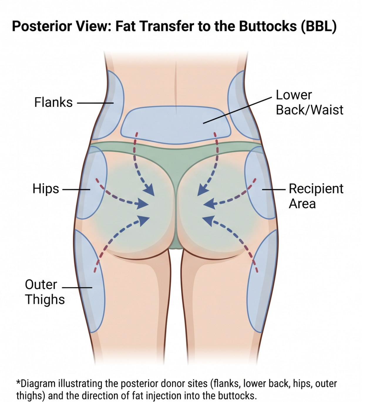 Diagram of fat transfer to the buttocks, showing donor sites: flanks, lower back, hips, outer thighs, and recipient area in posterior view.
