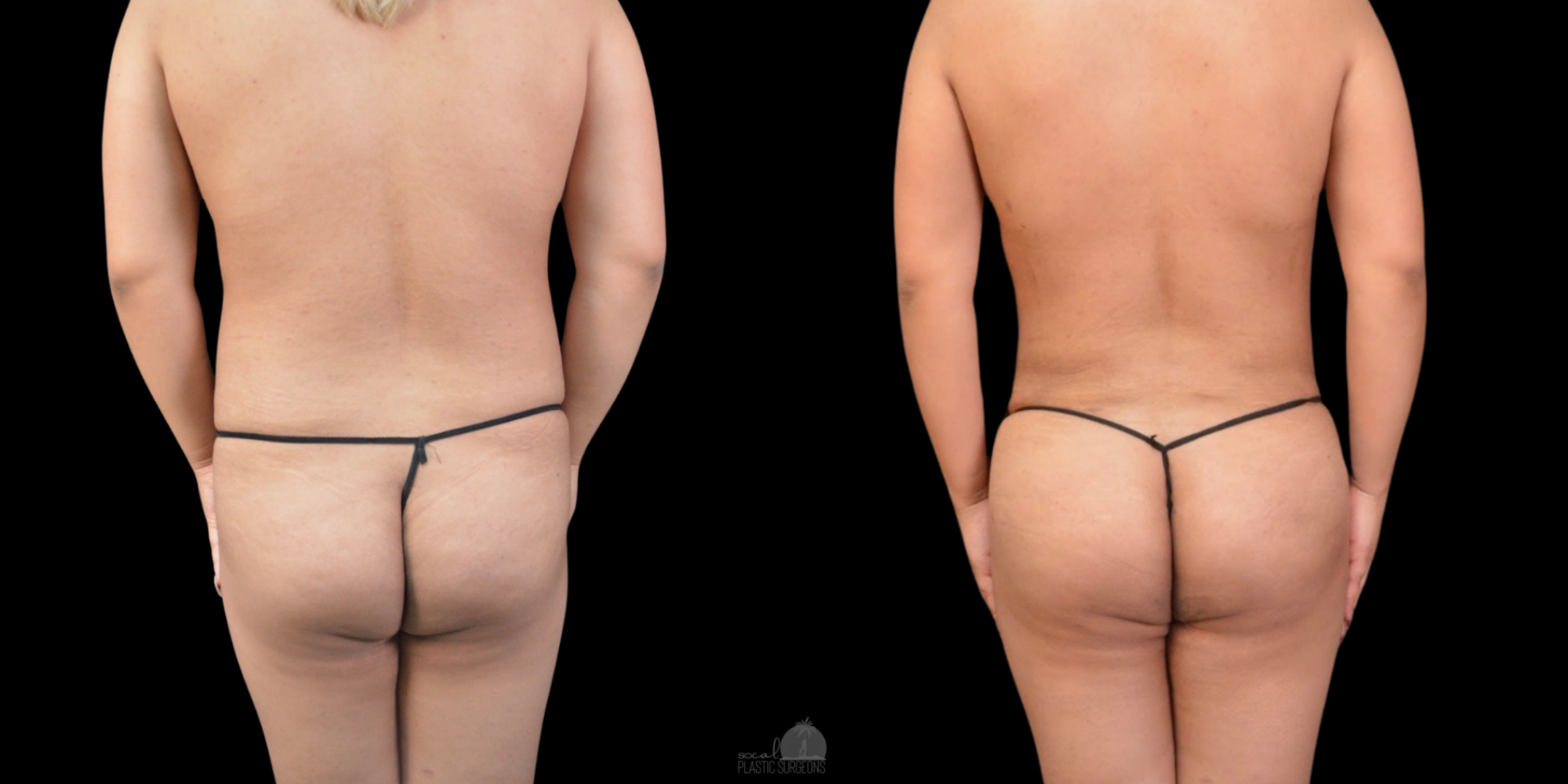 BBL Before and after woman