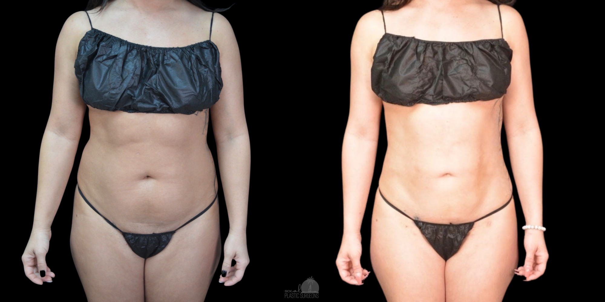 Liposuction before and after on woman