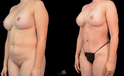 Mommy Makeover Before and after white woman