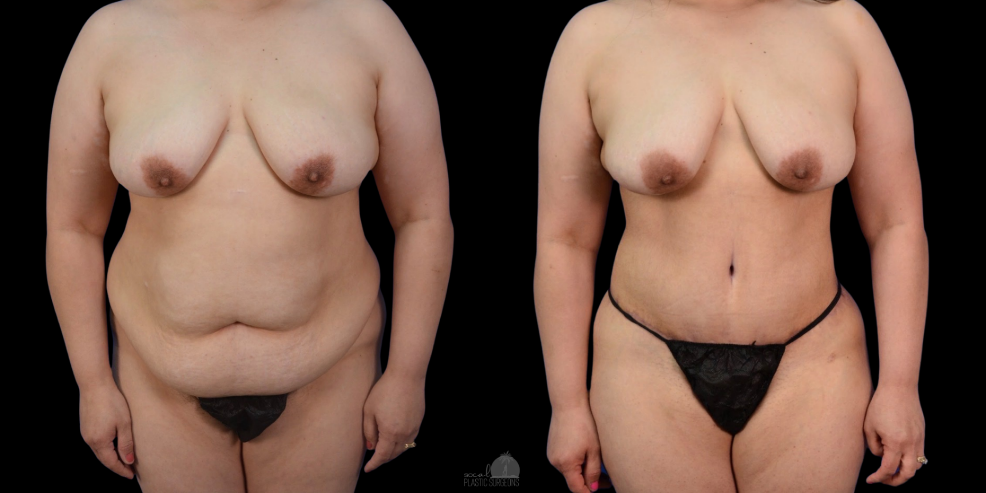 Tummy Tuck Before and after Front view