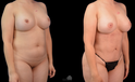 Mommy Makeover Before and after white woman