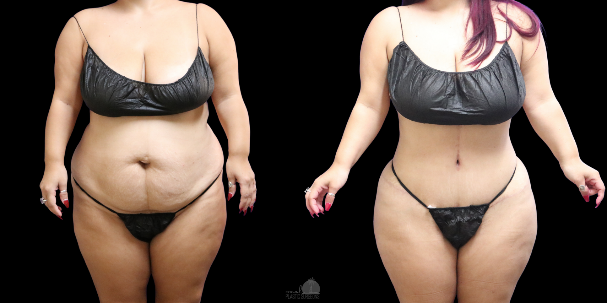 Mommy Makeover before and after