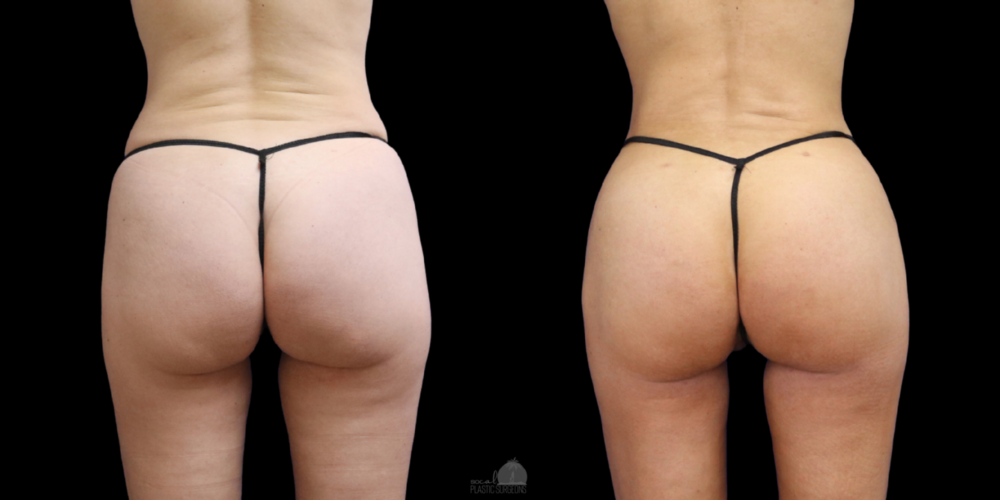 Woman Skinny BBL before and after