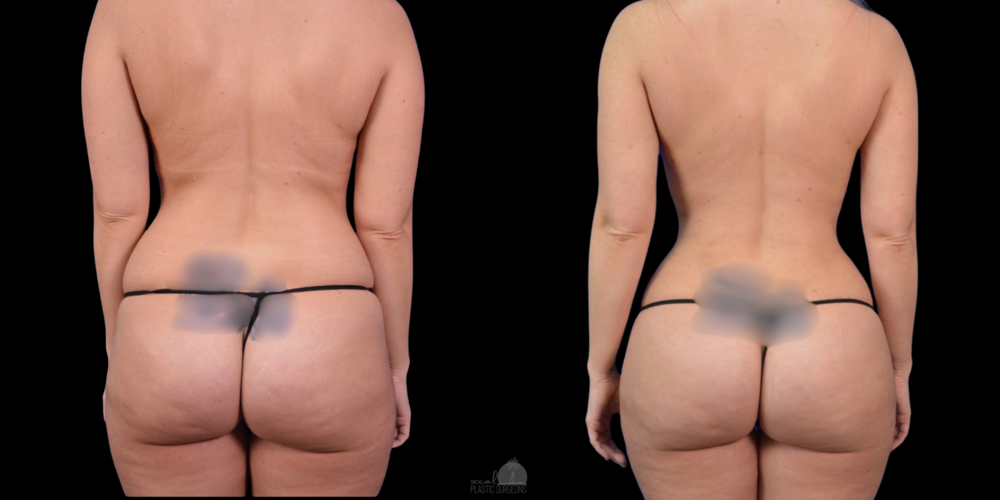 Woman BBL before and after