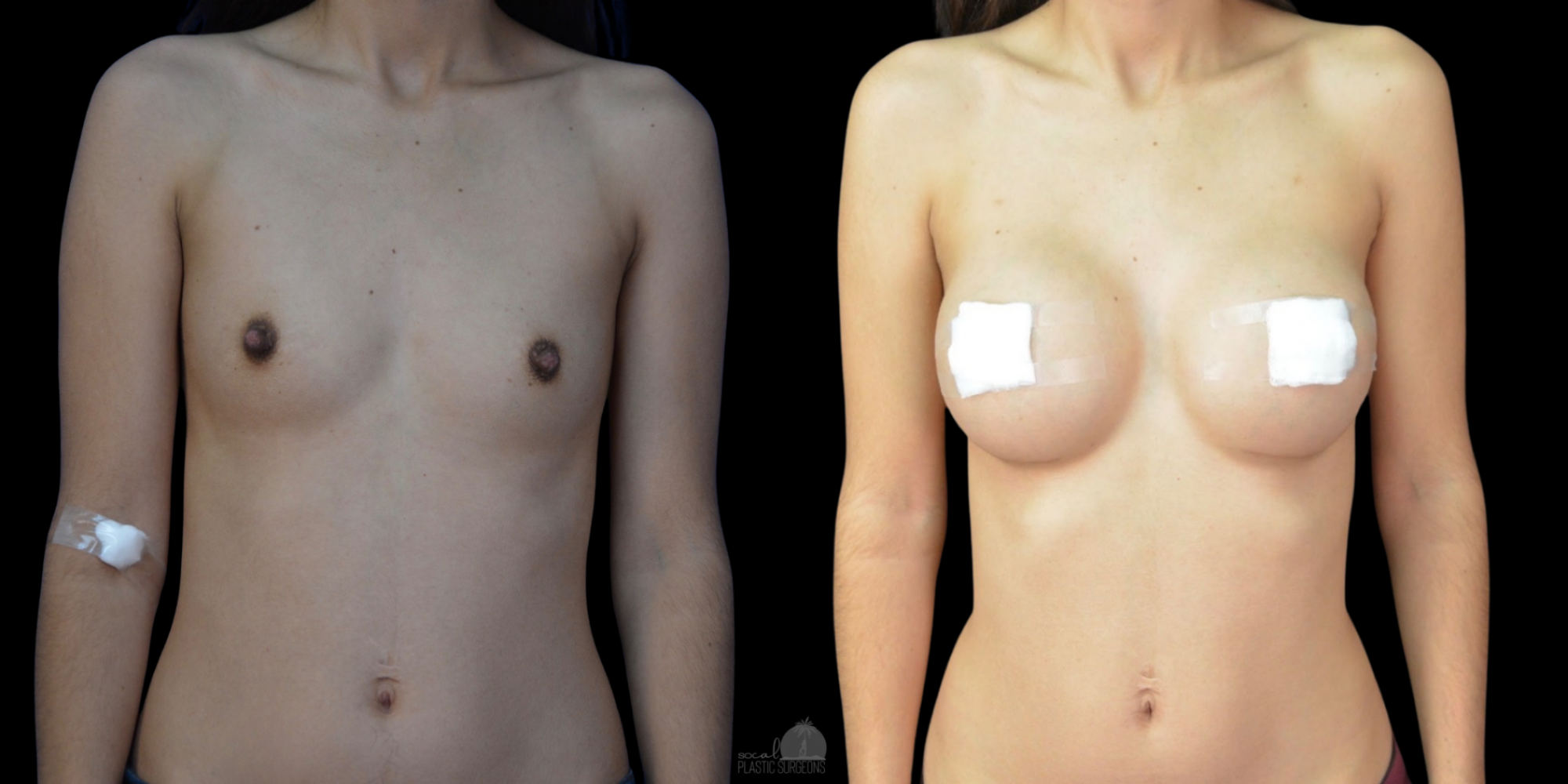breast augmentation before and after
