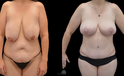 Mommy Makeover Before and after