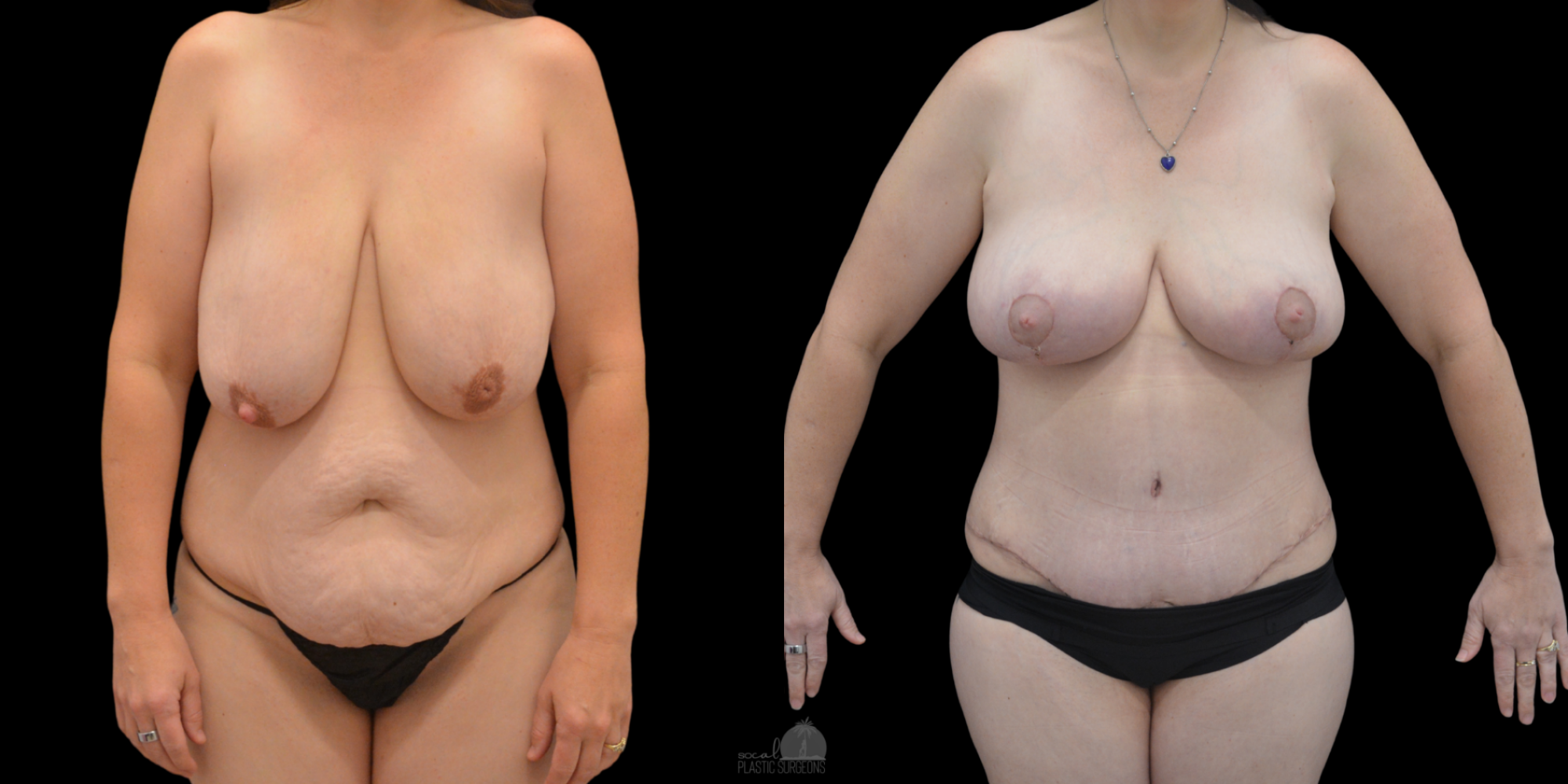 Mommy Makeover Before and after