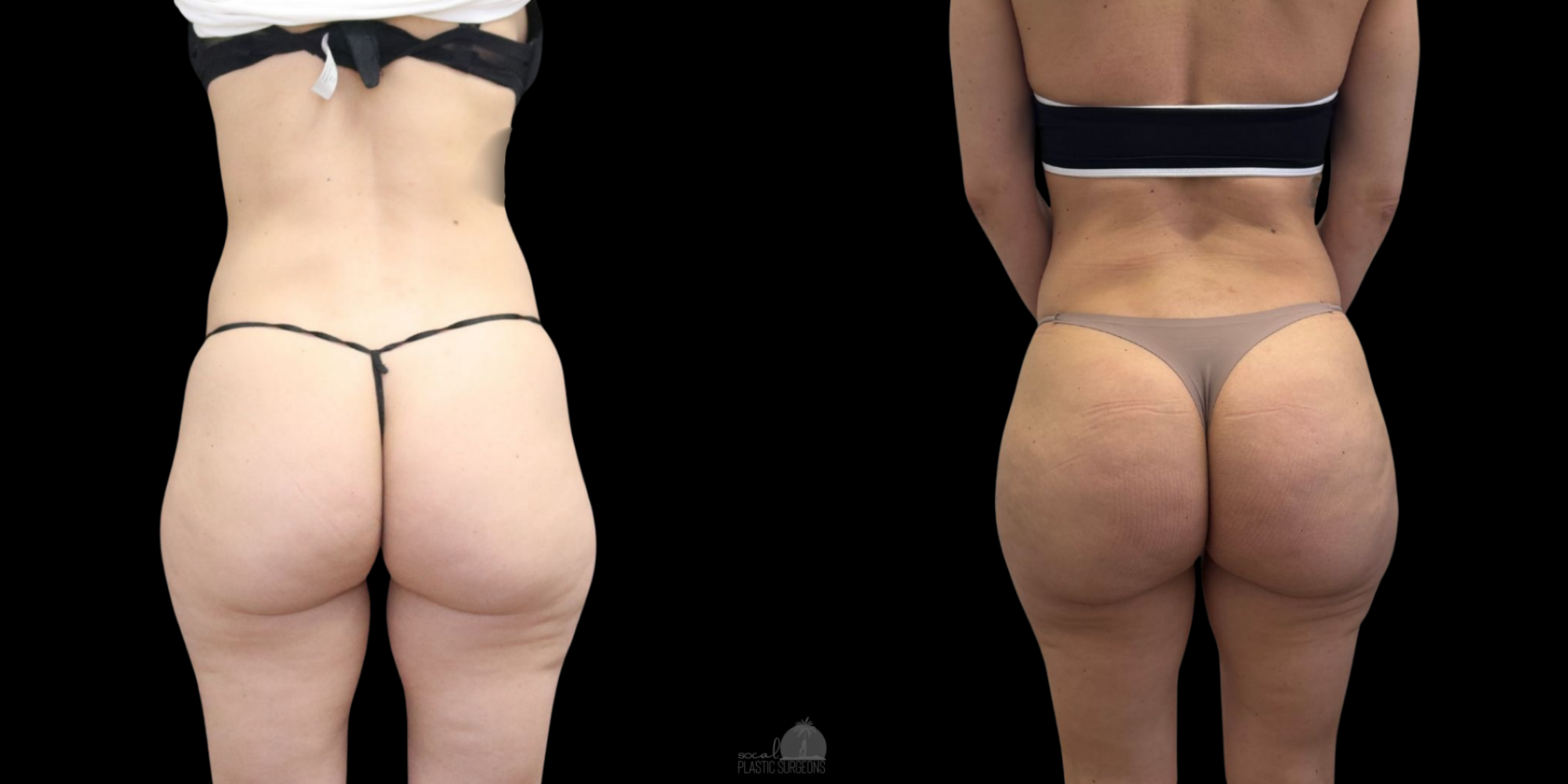 ALLOCALE BEFORE AND AFTER woman buttocks