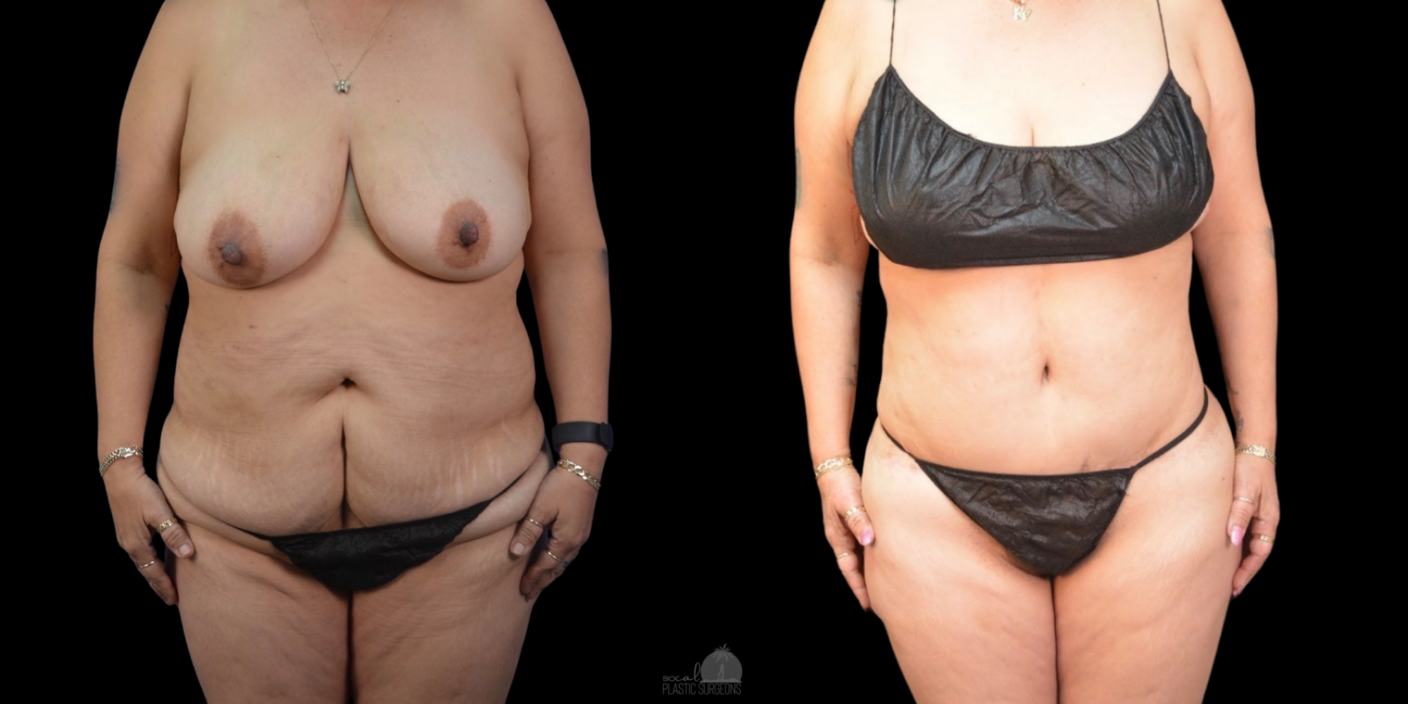 Woman Tummy Tuck Before and after Front view