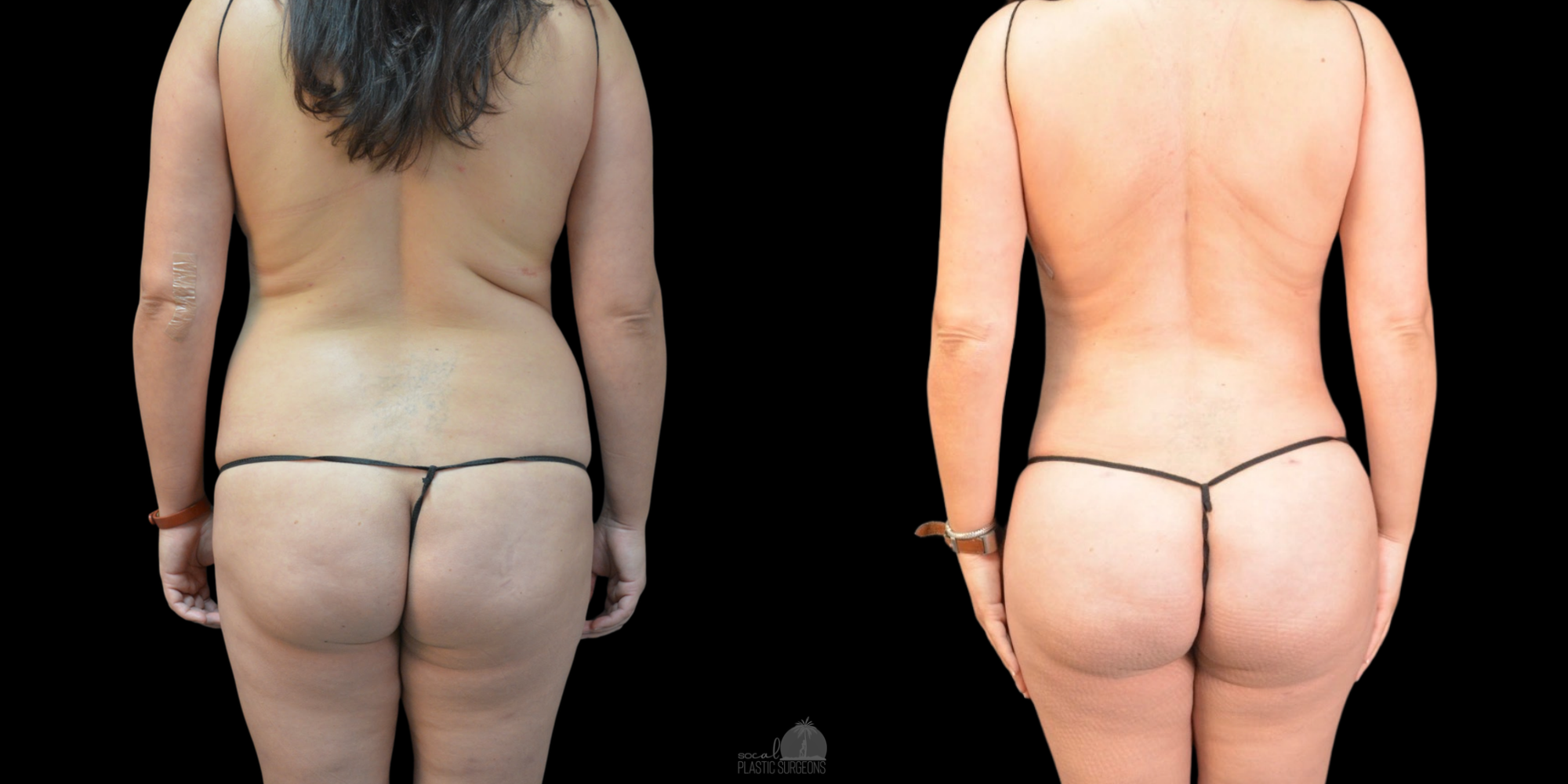 BBL Before and after woman Fat transfer
