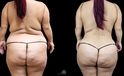 mommy makeover recovery before and after