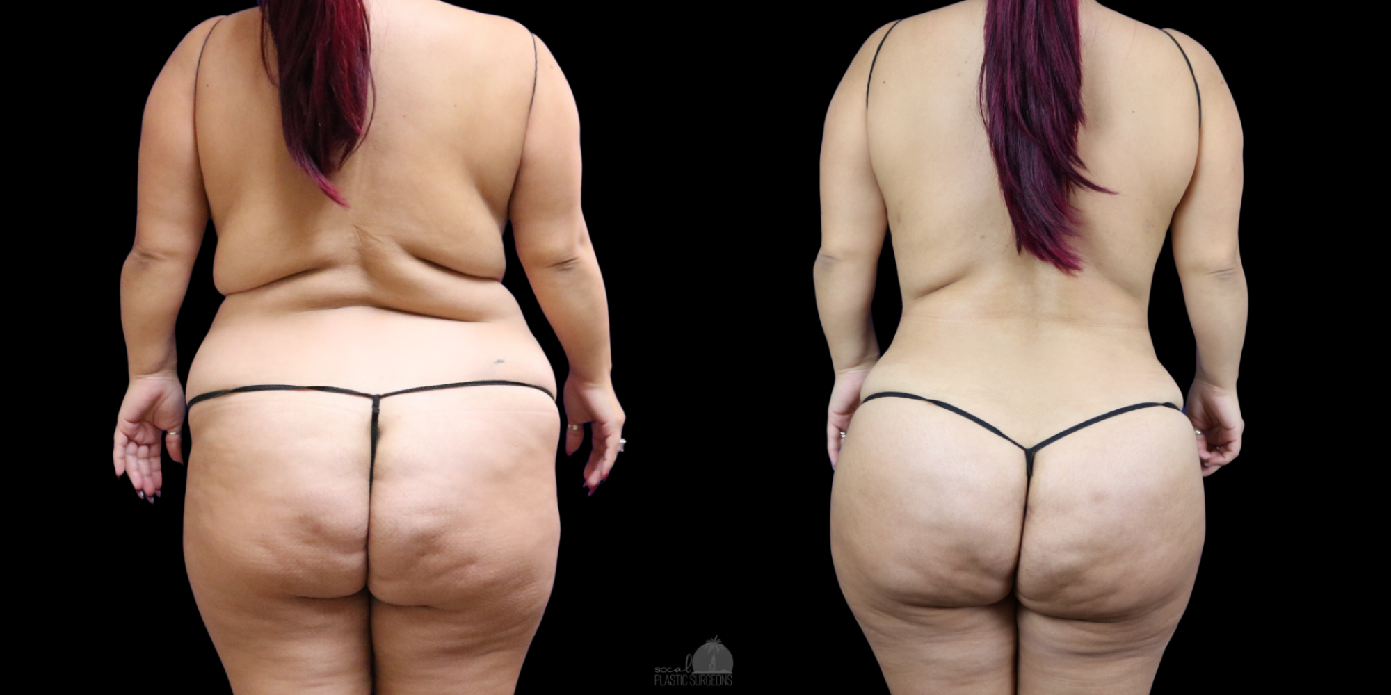 mommy makeover recovery before and after