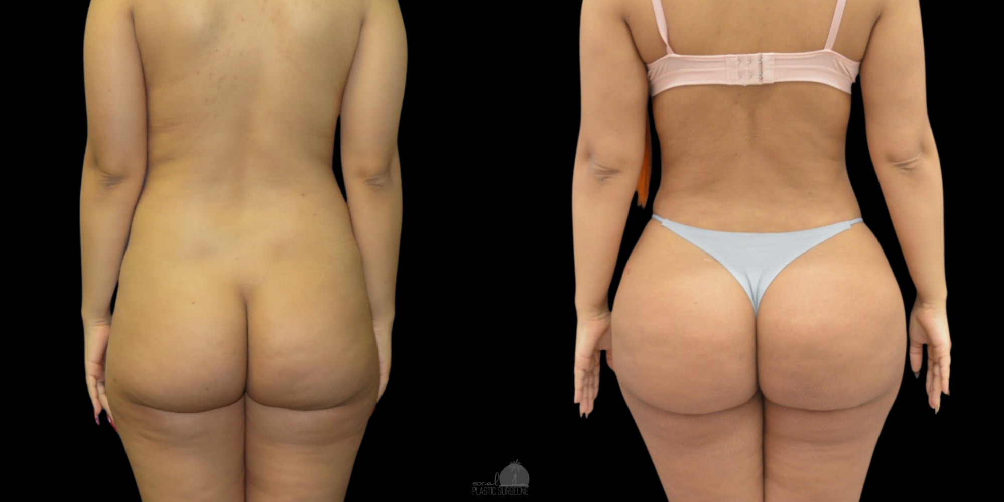 Before and after images of a woman's brazilain butt lift. The left shows her before, and the right shows her after wearing undergarments.