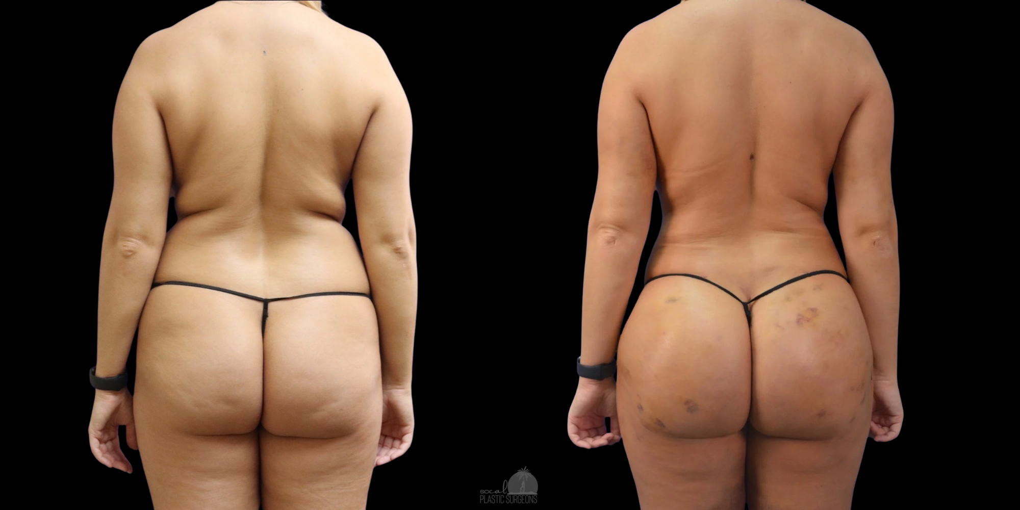 Fat trasnfer body sculpture before and after photo