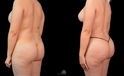 Mommy Makeover Before and after white woman
