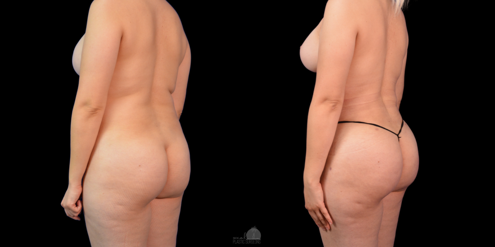 Mommy Makeover Before and after white woman