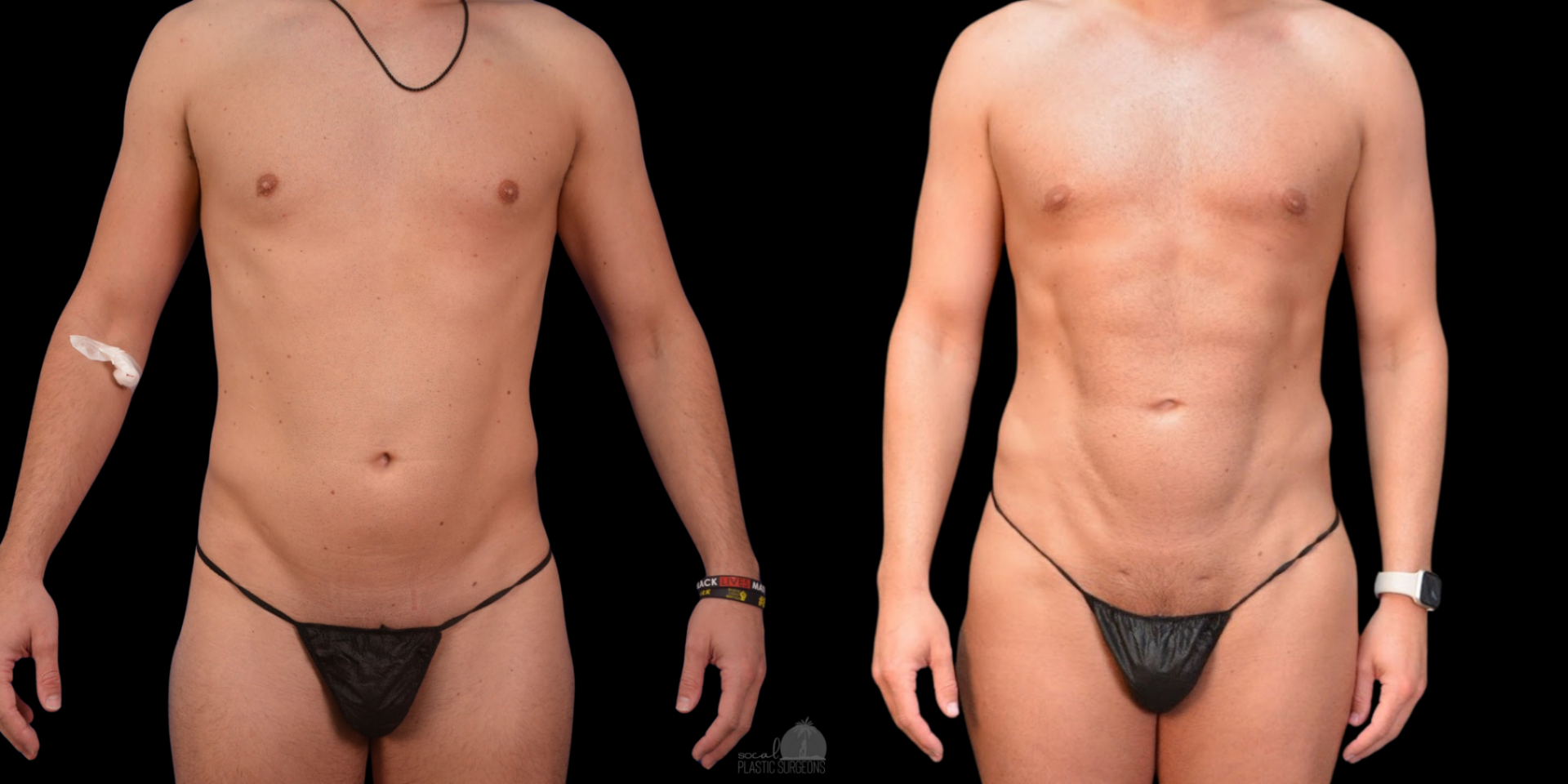 VASER BEFORE & AFTER