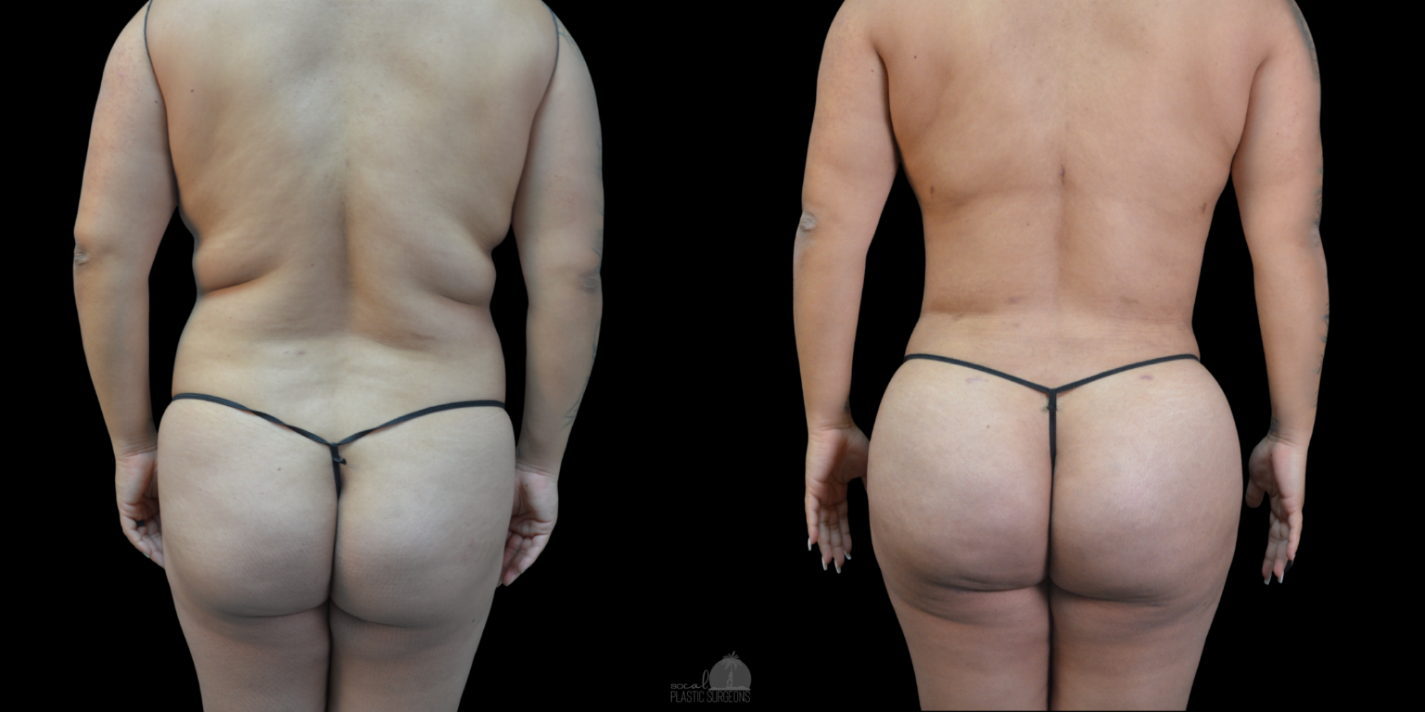 BBL Before and after woman