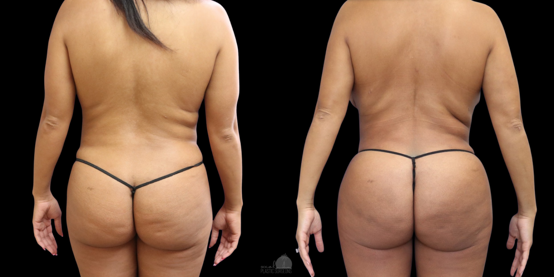 (LIPO 360+ FAT TRANS BBL)BEFORE AND AFTER