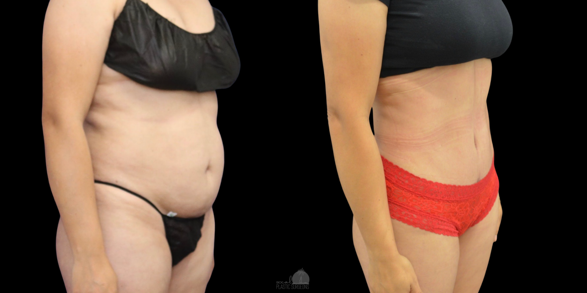 TUMMY TUCK BEFORE & AFTER